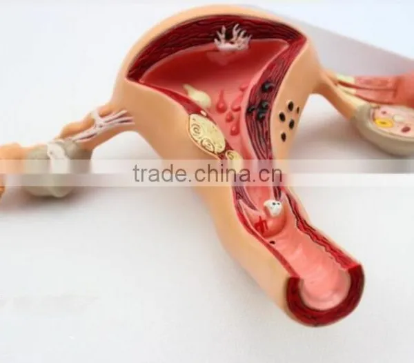 Human Uterus and Ovary Vaginal Pathological Changes Model of Reproductive Department of Gynecology Medical Demonstration Model photo-3