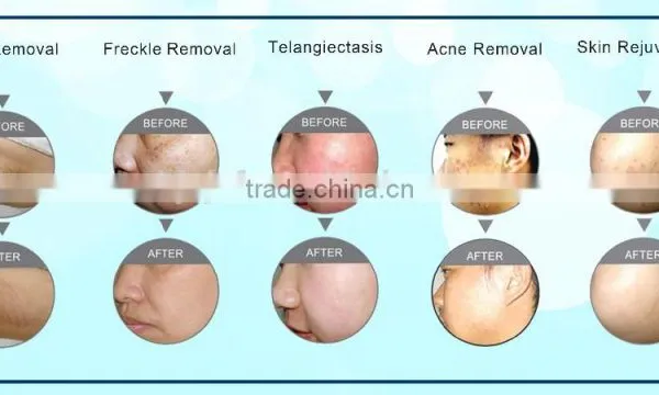 Most Popular IPL Hair Removal and Ipl Facial Rejuvenation Machine photo-6