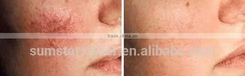8.4 Inch Touch Screen Vascular Removal /High Frequency Vascular Removal photo-4