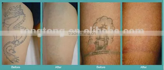 The Unique Tattoo Removal Machine Vascular Tumours Treatment Home Yag Laser Machine Med-810 1000W photo-6