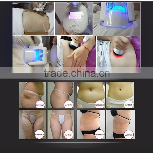 Medical CE Approved Cavitation Vacuum Freezing Fat Cell Cryo Slimming Machine photo-5