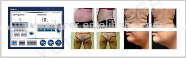 2015year Yuweilaser Ultracavitation Diode Laser photo-3