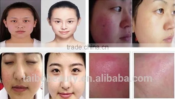 Beauty Cosmetics Laser Vascular Removal 980nm Diode Laser Spider Vein Removal Machine photo-6