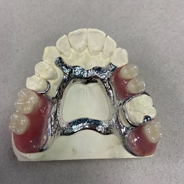 Full Metal Crown and Bridge photo-4