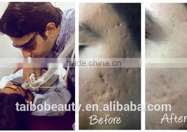 Birth Mark Removal Best Price !! Dermatology Laser Co2 Fractional Machine FDA Approved Skin Tightening / Vertical Co2 Fractional Laser For Vaginal Tightening 1ms-5000ms photo-5