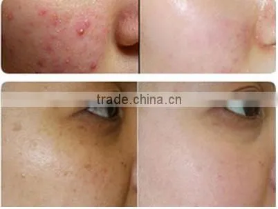 Medical Skin Tightening Fractional Co2 Laser Equipment Skin Treat Telangiectasis Age Spot Removal Rejuvenation Co2 Laser Scar Removal Acne Treatment Face Lifting photo-4