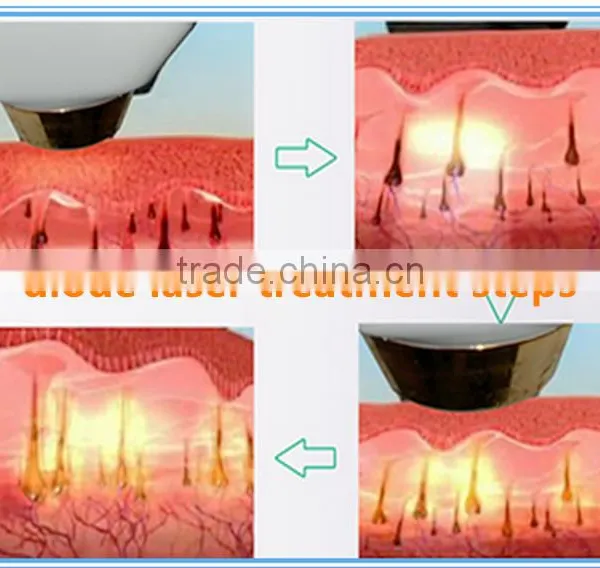 Best Selling Products Shr Diode Lasers 808 nm / Alexandrite Laser 755nm photo-5