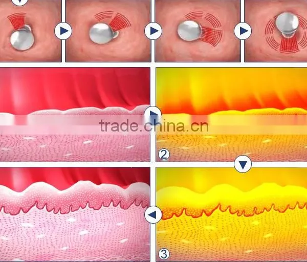 Forehead Wrinkle Removal Factory Price 10000 Times Hifu Vaginal Tightening Machine/vaginal Rejuvenation High Focused Ultrasonic photo-6