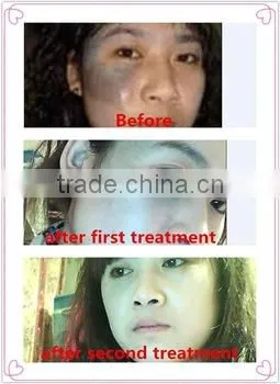 Varicose Veins Treatment Laser Type Physical Therapy Equipment/long Pulse Hori Naevus Removal Nd Yag Laser/best Tattoo Removal Machine photo-6