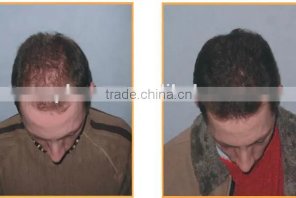 650nm Laser Hair Loss/ Hair Growth Machine (with CE Certification) photo-4