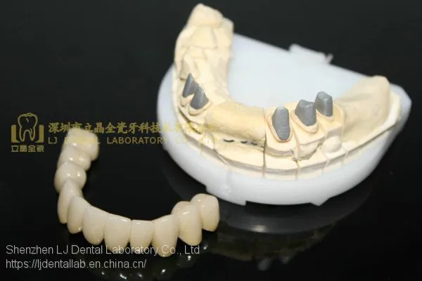 Full Metal Post Core, Full Ceramic Post Core, Richmond Crown, Cast Metal Crown, Dental Prostheses, Laboratorio Dental, Dental Laboratory, Dentallabor, LJ Dental Lab China photo-5