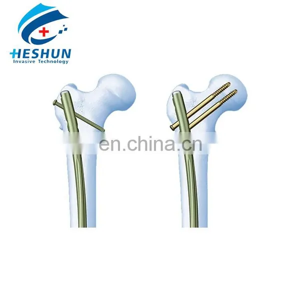 Humerus Interlocking Nail