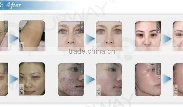 Laser Hair Removal Fda Approved Ipl Laser Machine photo-2