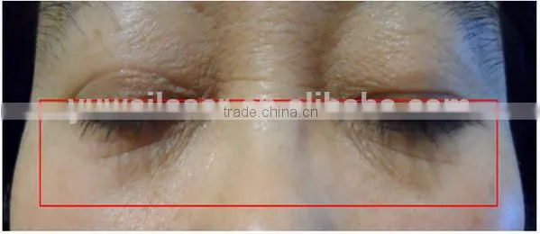 Pigment Removal Hot Promotion!!! HIFU Body Slimming 0.2-3.0J Body Slim Equipment & Machine photo-6