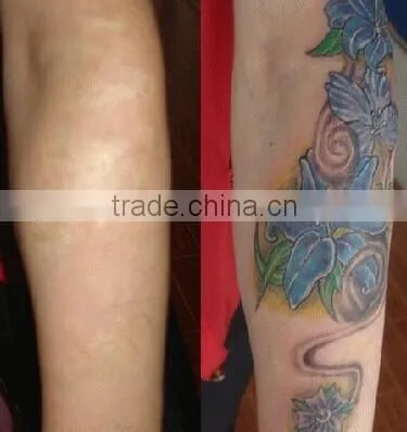 Manufactory Portable nd Yag Tattoo Removal Laser With Medical CE in Cheapest photo-6