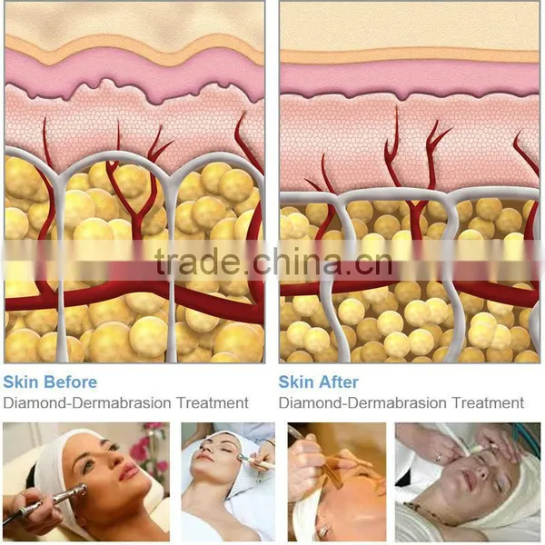 Fast Remove Dead Skin Surface/scars Microdermabrasion Machine photo-3
