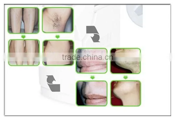 Oem Medical Luxurious Design Portable 808nm Machine Diode Laser Hair Removal Permanent photo-6