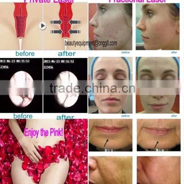 Supercritical Co2 Extraction Machine for Acne Scars Treatment , Burn Debridement photo-5