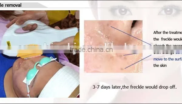 Best Facial Removal Salom Beauty Machine With Beauty Energy Bar photo-5