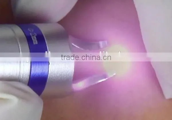 980nm Spider Vein Removal China 15w Diode Laser Price for Beauty Clinic photo-3