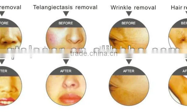 Beauty Equipment With IPL System to Remove Pore,acne, Wrinkles, Freckles photo-2