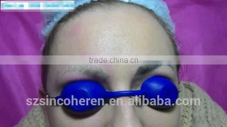 nd Yag Laser Tatoo Removal Machine Carbon Peeling Treatment for Skin Rejuvenation photo-5