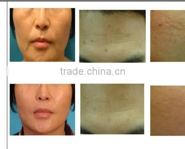 Professional 2 Handles / 5 Handles Micro Needle Fractional rf Wrinkle Removal Machine With Different Size Tips photo-6