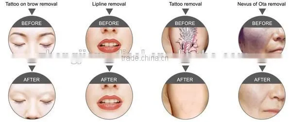 Zhengjia Medical Q Switched Nd Yag Laser For Tattoo 1-10Hz Removal/ Tattoo Removal Machine For Sale Varicose Veins Treatment photo-3