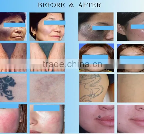 Professional Medical nd Yag Laser/q Switch nd Yag Laser Tattoo Removal Machine/ 532nm 1064nm Laser Pigmentation Removal Machine photo-6