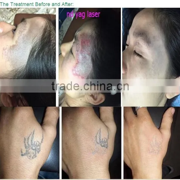 Newest nd Yag Laser Price Tattoo Removal Machine for Age Spot Removal photo-5
