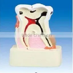 Diseased Teeth Model