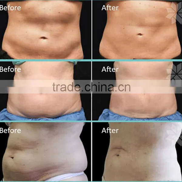 Non Surgical Ultrasound Fat Removal Top 1 Vertical Vacuum Cavitation System Non Surgical Ultrasonic Liposuction Type And Supersonic Operation System Slimming Machine photo-6