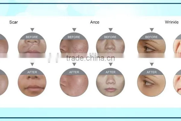 F5 Portable Style Fractional Home Laser Scar Removal Fractional Co2 Laser photo-5
