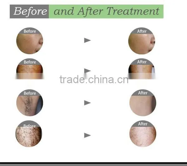 HOT Low Price Depitime Hair Removal/virgin Hair Removal/cheapest IPL Hair Removal photo-5
