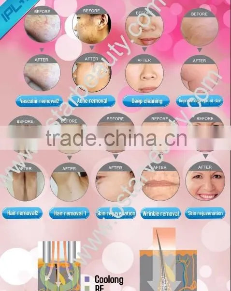 2016 New IPL Laser Hair Removal Machine photo-2