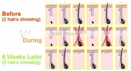 530-1200nm Economic Vertical Big Energy Elight Remove Tiny Wrinkle Ipl Machine&device For Hair Removal Vascular Lesions Removal photo-2