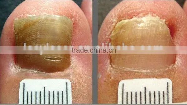 Ipl Laser Hair Removal Beauty Parlor Machine for Sale photo-3