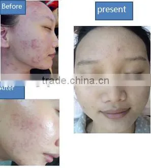 Skin Analysis 2013 Oxygen Facial Machine Oxygen Jet Peel&No-needle Mesotherapy Machine For Sale-Oxy Skin Moisturizing photo-3