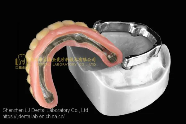 Dental Implant Bar, Implant Overdenture, Implant Prosthesis, Laboratoire Dentaire, Dentallabor, Laboratorio Dental, Dental Laboratory, Shenzhen LJ Dental Lab China photo-4