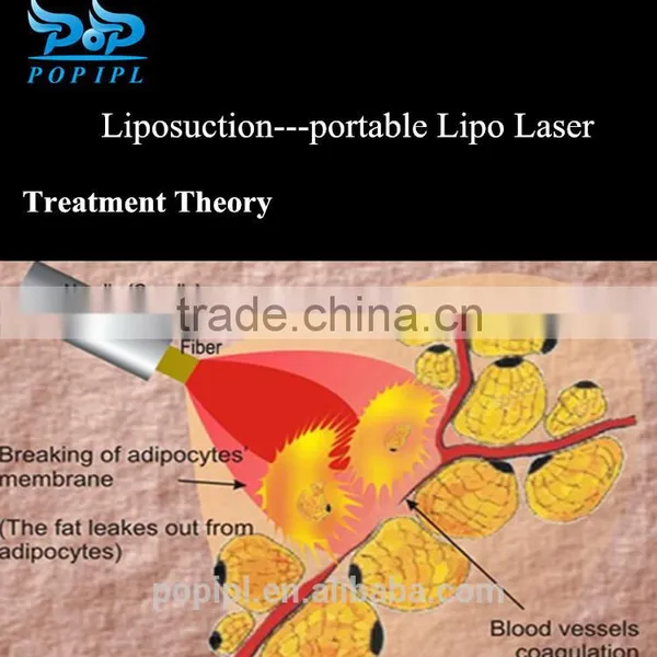 Laser Suction Portable Lipo Laser Slimming Machine For Weight Loss CHINA POPIPL photo-4