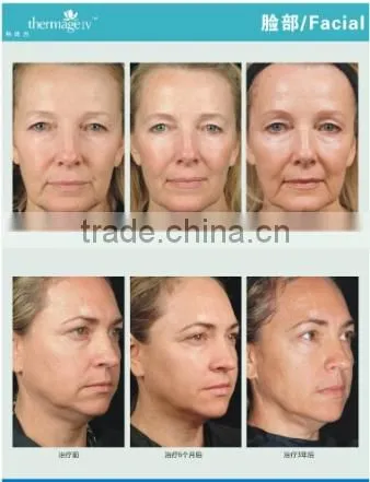 AYJ-C19(CE) Dot Matrix Portable Thermal rf Beauty Equipment Fractionel photo-6
