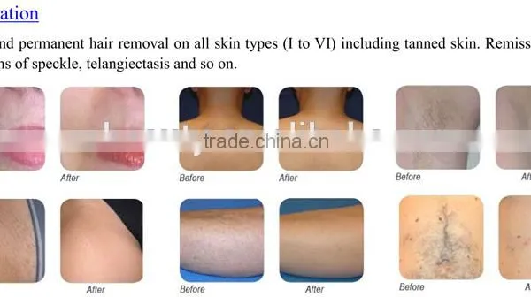 808nm Diode Depilation Laser Home Hair Removal Equipment Depilation Laser Home photo-3