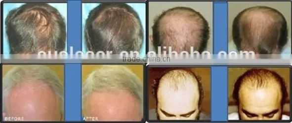 Led Light Therapy Home Devices PDT Laser Hair Growth Led Light Therapy For Skin /best Hair Loss Treatment Machine photo-6