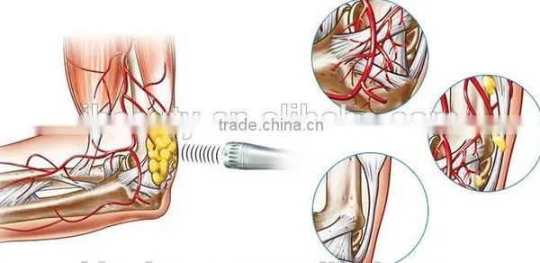 2016 New Physiotherapy Extracorporeal Shoulder Pain Therapy Equipment Shockwave Machine photo-6