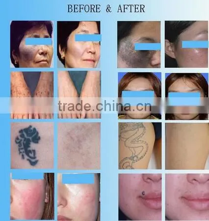 CE Approved New Handheld Tattoo Removal Laser Beauty Spa Machine for Sale q Switch nd Yag Pigment Freckle Removal photo-5