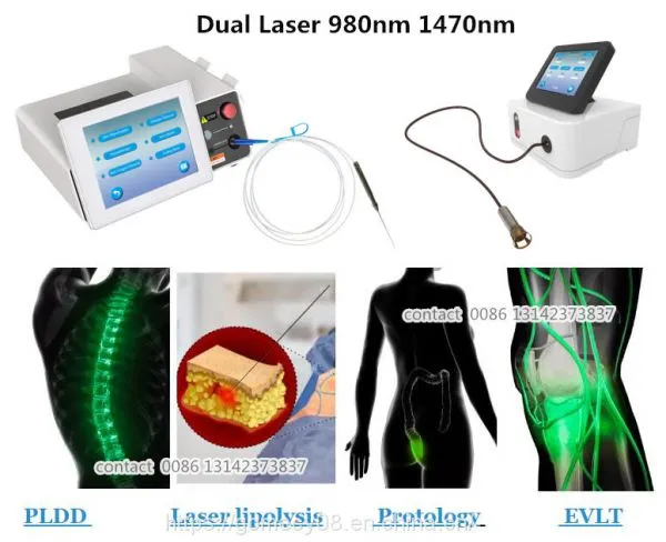 Surgical Laser Diode 980nm 1470nm Physical Therapy Bare Fiber Radial Fiber Hemorrhoids PLDD Treatment