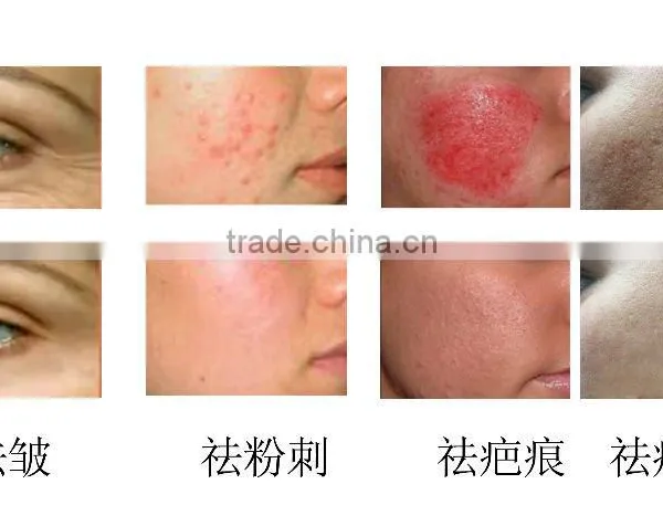Perfect Beauty Salon Use Microneedle Fractional rf System photo-6