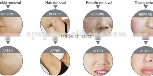 GIR-10 E-light (IPL+laser +RF) Multifunctional Beauty Care Machine for Sale Beauty Skin Care Machine photo-3