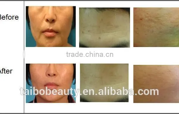 TaiBo Beauty Professional Portable Fractional rf Machine/rf Fractional Micro Needle/fractional rf Microneedle Machine photo-6