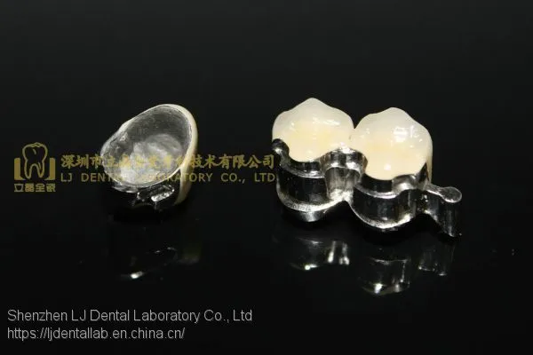 Dental Precision Attachment, Dental Attachment, Dental Denture, Laboratoire Dentaire, Dentallabor, Laboratorio Dental, Dental Laboratory, Shenzhen LJ Dental Lab China photo-3